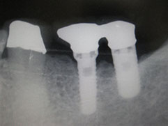 インプラント治療の症例